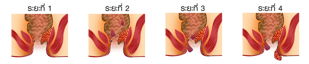 ระยะของริดสีดวง