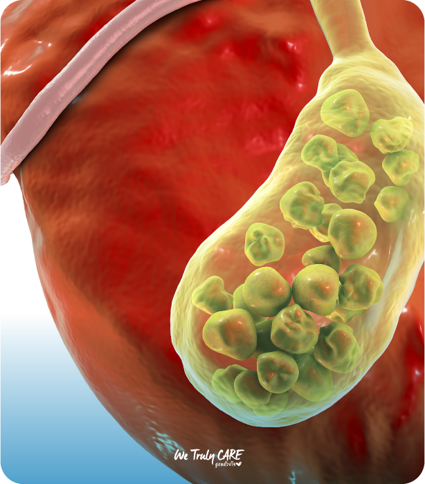 การตรวจหานิ่วในถุงน้ำดี