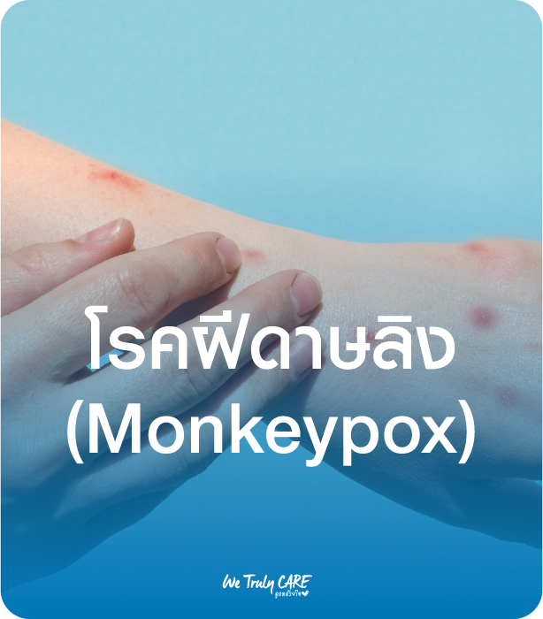 โรคฝีดาษลิง (Monkeypox)