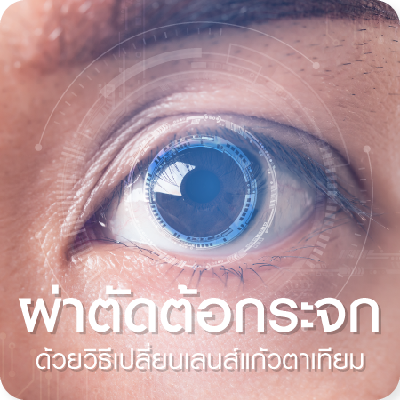 แพ็กเกจผ่าตัดต้อกระจก