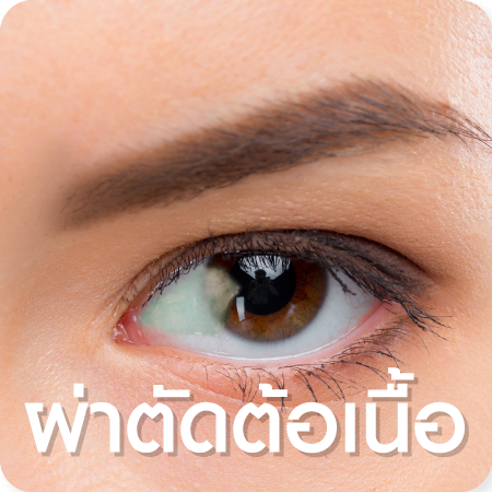 แพ็กเกจผ่าตัดต้อเนื้อ