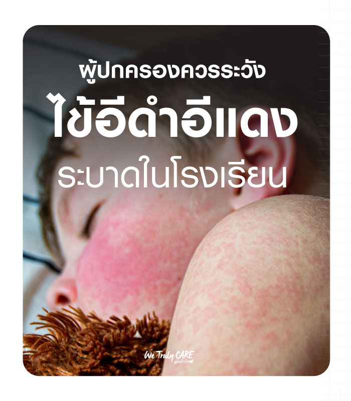 ผู้ปกครองควรระวัง ไข้อีดำอีแดง ระบาดในเด็กวัยเรียน